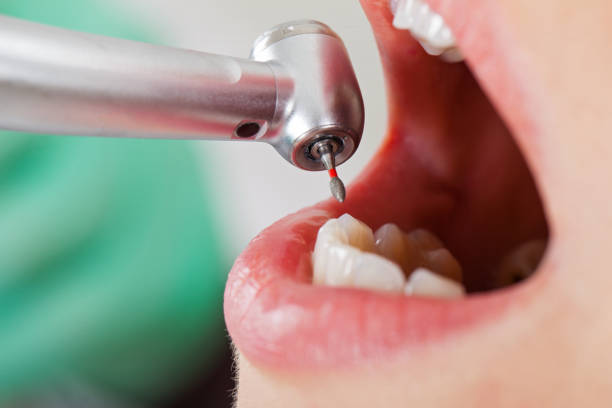 Best Emergency Dental Extractions in Oxford, GA